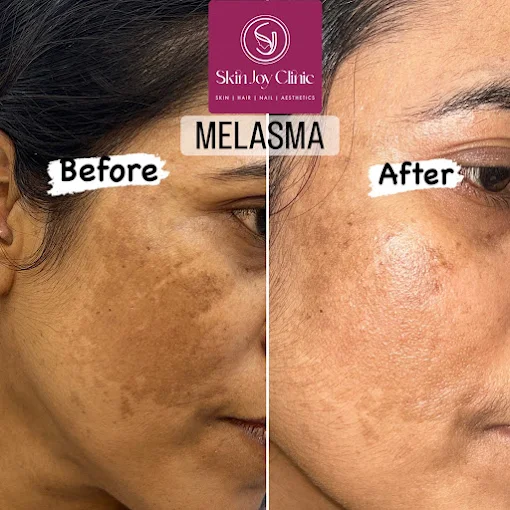 Pigmentation Correction